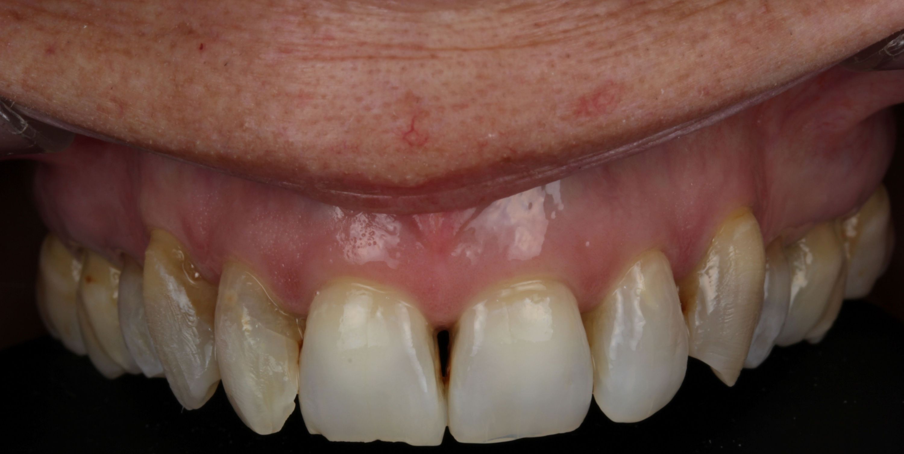 Top row of teeth with signs of wear and chipping